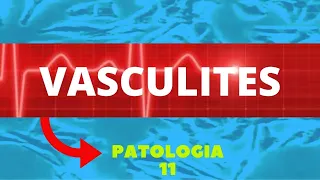 VASCULITES - ENTENDA A VASCULITE E SEUS TIPOS - PATOLOGIA 11