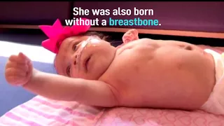 UK baby born with heart outside her body survives