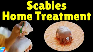 Scabies Home Treatment | Home Remedies for Scabies to Speed Up Treatment | How to Treat Scabies