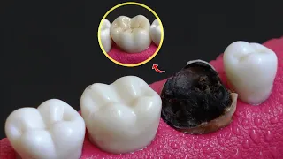 Unbelievable Restoration of Hopeless Decayed Tooth | Zirconia Crown In 4K.