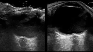 Optic nerve sheath diameter, Papilledema Ultrasound. Pseudotumor Cerebri: 12/2020