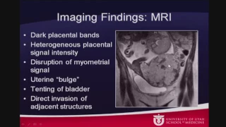 Imaging Placenta Accreta