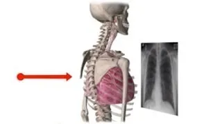 Chest X-Ray Basics in 5 min