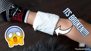 MY BROTHER BROKE HIS LEG MUST WATCH!!!!!!!