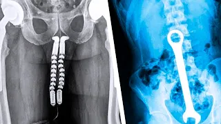 20 Strangest Things Found In An X-Ray