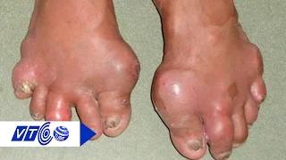 Điều trị bệnh gout bằng Đông Y hay Tây Y? | VTC