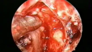 Vidian Neurectomy -  Prof. P.J.Wormald