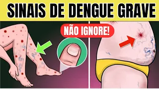 12 SINAIS ESTRANHOS de DENGUE e 4 SINAIS de PERIGO EXTREMO