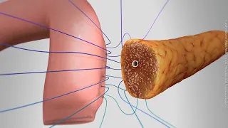 Two-layer bowel anastomosis-style pancreaticojejunostomy ("Dunk" PJ technique)