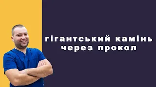 Гігантський камінь нирки видалено через тонкий прокол / лікар-уролог Камінський Валерій