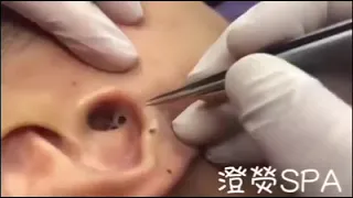 Blackhead Removal