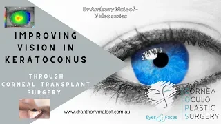 Improving vision in Keratoconus through corneal transplant surgery   Dr Maloof   Sydney, Australia.