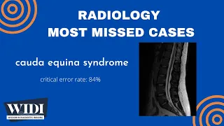 Most Missed Cases: Cauda Equina Syndrome
