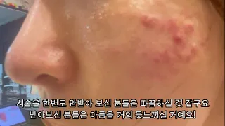 여드름 흉터필러+쥬베룩(스킨) 리얼후기 2탄