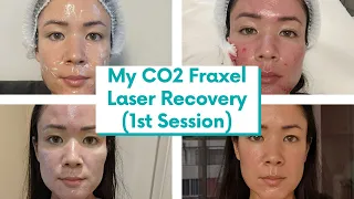 I FINALLY Got CO2 Fraxel Laser for my Atrophic Acne Scars! Recovery Vlog | @michxmash