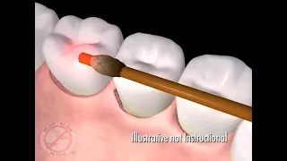 LANAP - Laser Assisted Gum Regeneration