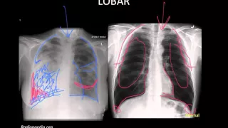 Pneumonia: Imaging