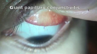 Giant papillary conjunctivitis