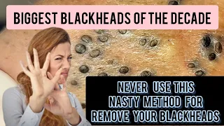 Nasty and lengthy blackhead removal (bent needle) historical method...  @Dr.AMAZINGSKIN