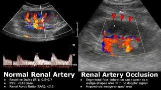 Renal Artery Doppler Ultrasound Normal Vs Abnormal Images | Stenosis/Occlusion/AVM | Kidney USG