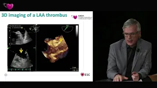 EACVI free webinar: How to use contrast to rule out left atrial appendage thrombus