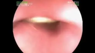 Endoscopic Removal of Foreign Body from Esophagus (Indian 5 Rupees Coin)