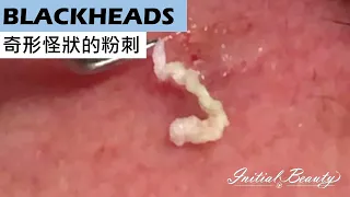 深層黑頭粉刺(blackheads) - Taiwan Tainan台南清粉刺最乾淨