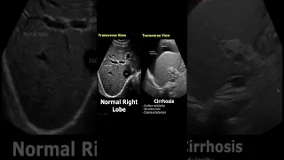 Liver Cirrhosis On Ultrasound | Ascites | Chronic Liver Disease USG  Normal Vs Abnormal #shorts