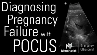 Diagnosing Pregnancy Failure with POCUS