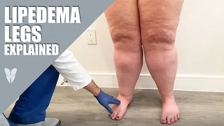 Lipedema Legs Explained | Dr. Jaime Schwartz | Total Lipedema Care