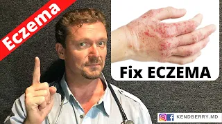 Is this Causing Your ECZEMA? (Easy Way to Tell) 2024