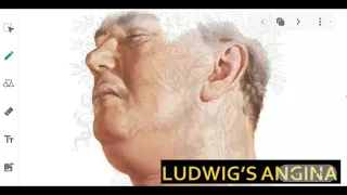 || LUDWIG'S ANGINA || IN JUST 5 MINUTES !!