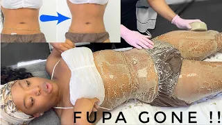 I tried Freezing my BELLY FAT for the 1st Time & it Worked | Sculpt-Ice & Wood Therapy Fat Treatment