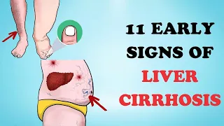 11 Early Signs of Liver Cirrhosis | Healthy Care