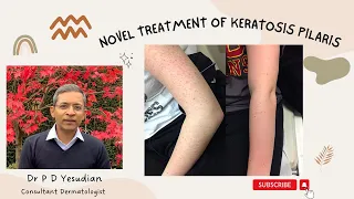 A novel treatment for Keratosis pilaris