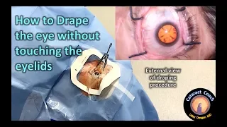 Draping the eye for cataract surgery without touching the eyelids