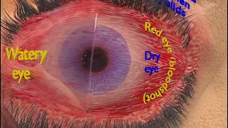 thyroid eye disease I thyroid eye hypothyroidism I eye hyperthyroidism - what is graves'  disease? I