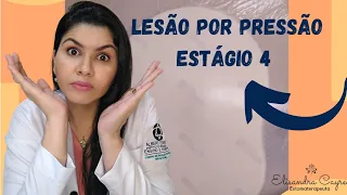 LESÃO POR PRESSÃO - ESTÁGIO 4 - ESTOMATERAPIA