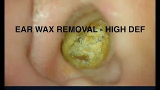 Ear Wax Removal - HIGH DEF