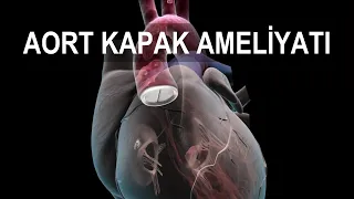 KALP KAPAĞI AMELİYATI | Aort Kapak Ameliyatı