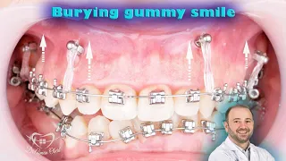 Gummy smile correction by mini implants, upper teeth lifting, gummysmile treatment without surgery