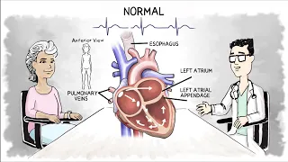 AtriCure Patient Atrial Fibrillation Animation