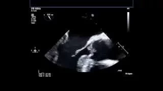 Echocardiograms before and during Treatment