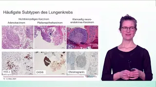 Tumordiagnstik durch die Pathologie an kleinsten Gewebsstückchen | Dr. Hannah Füllgraf