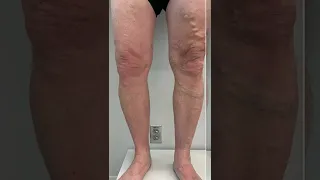 Sclerotherapy Before/After