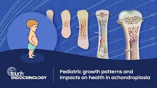 Pediatric growth patterns and their impact on health: Achondroplasia in focus