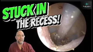 STUCK IN THE RECESS! 267 #ear #earwax #earwaxremoval #earcleaning #fyp #asmr #asmrearwax #satisfying