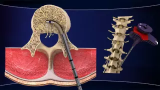 INTRACEPT Intraosseous Nerve Ablation System