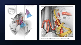 Far Lateral Craniotomy for Trapping of a Ruptured Dissecting V4 Vertebral Artery Aneurysm