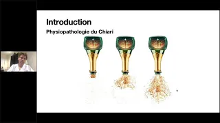 Demandez a  L'Expert - Cyrille CAPEL, Neurochirurgien: Les Malformations de Chiari de Type 1